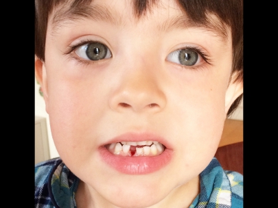 first milk tooth out!